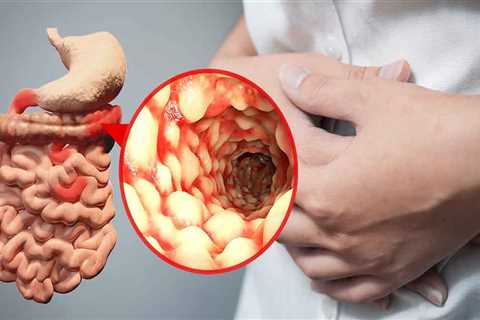 What is Crohn’s Disease?