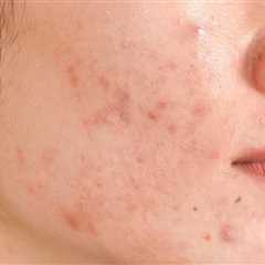 Acne Scars: Types & Most Effective Treatment Options