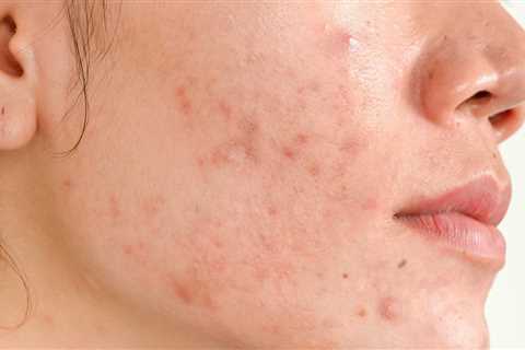 Acne Scars: Types & Most Effective Treatment Options