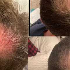 Hair Loss Restoration Havertown, PA · Tuesday, May 13 📸
