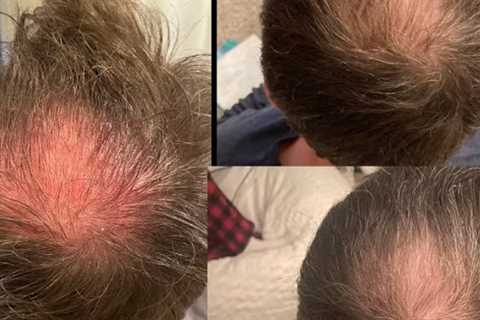 Hair Loss Restoration Havertown, PA · Tuesday, May 13 📸